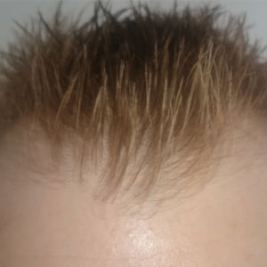 Before the hair transplant operation