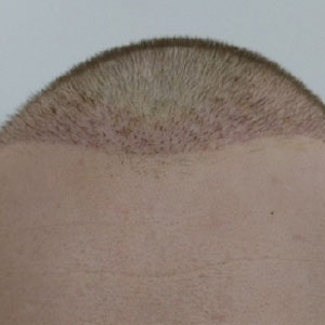 During the hair transplant operation