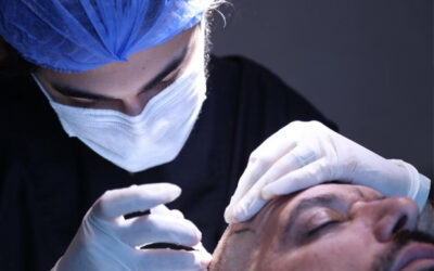 How can we minimize swelling after the hair transplant?