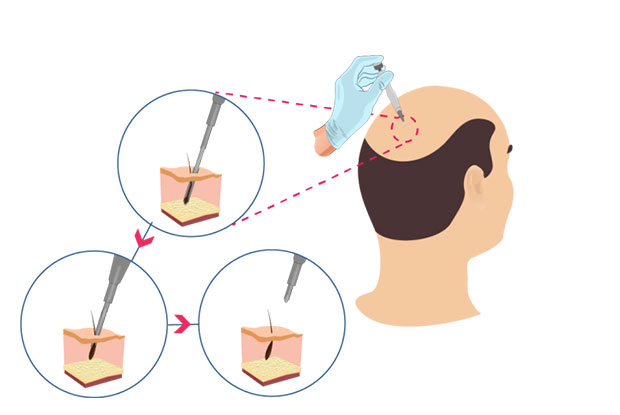 How is the hair transplant performed?