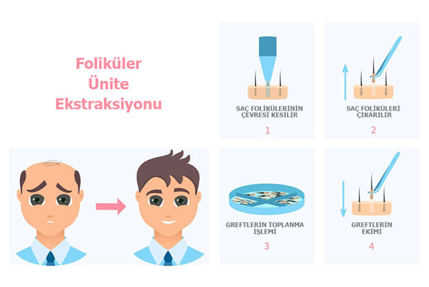 Stages of FUE hair transplantation