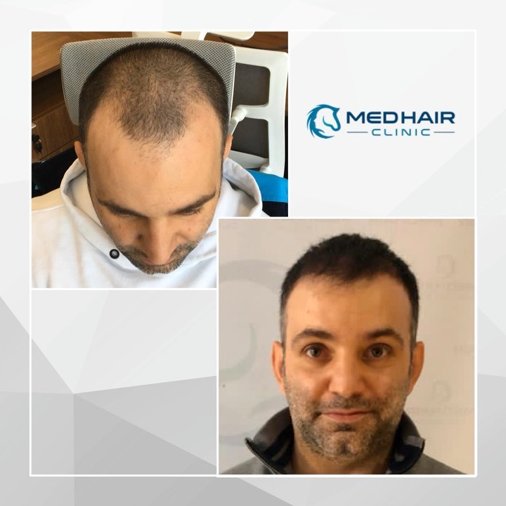 Best Hair Transplant Turkey | Medhair Clinic