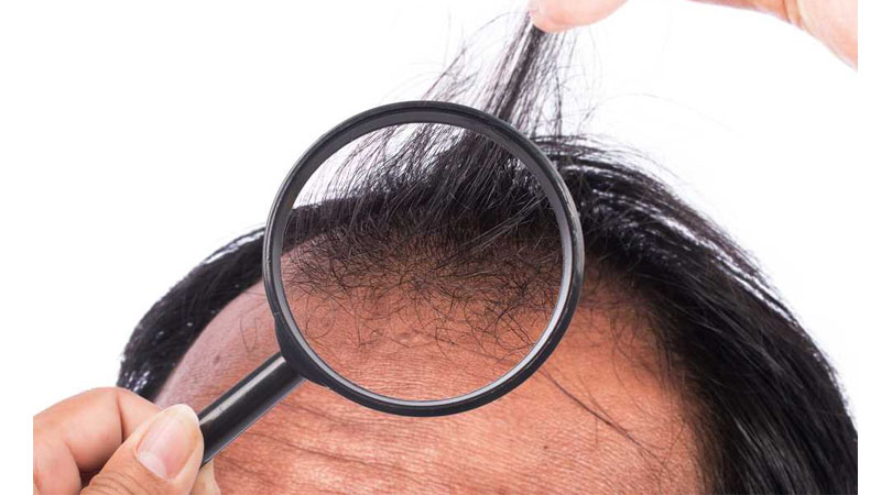 Que dois-je faire pour éviter la perte de cheveux?