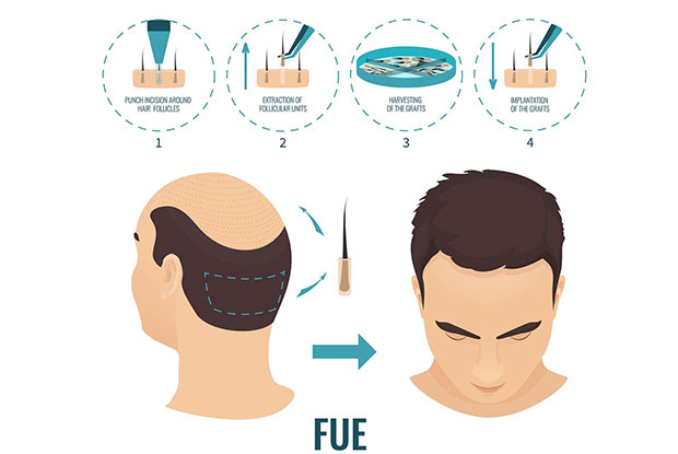 How is the FUE Hair Transplant performed?
