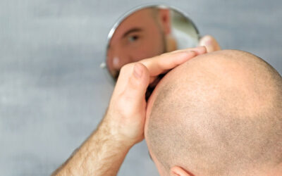 Is Everyone suitable for Hair Transplantation?