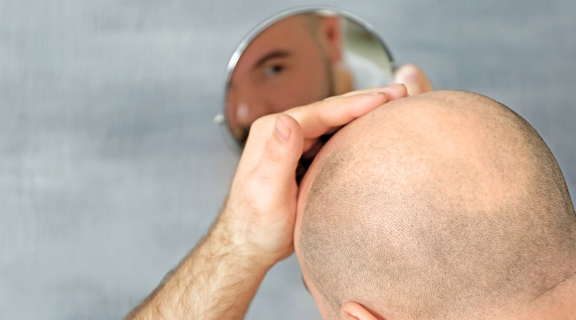 Is Everyone suitable for Hair Transplantation?