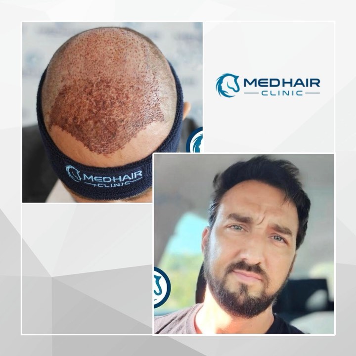 Before and After Hair Transplant
