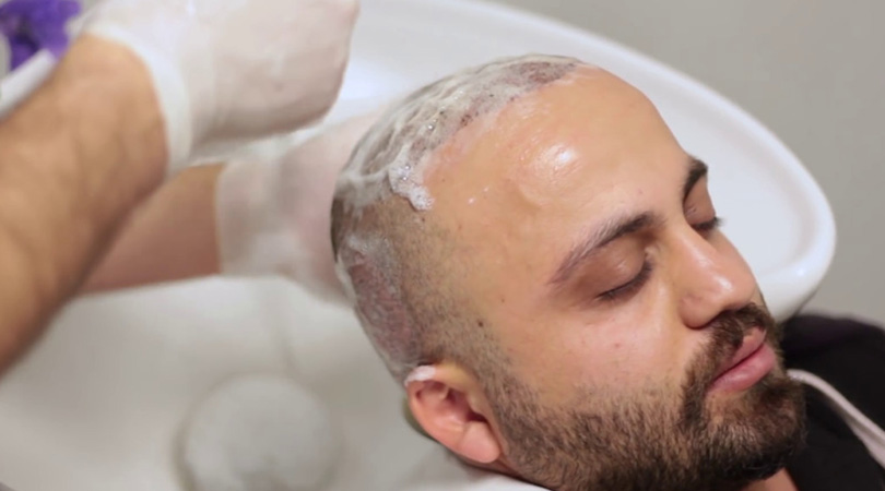 Lavagem de cabelo pós-operatória